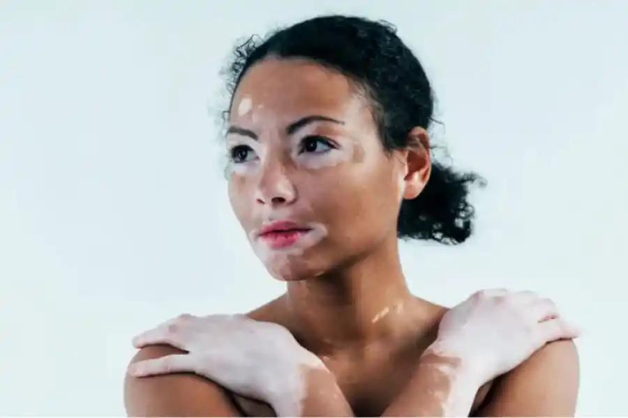 Día Mundial del Vitiligo: a quiénes afecta y cuáles son sus síntomas