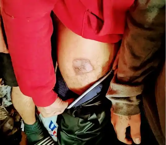 CONSECUENCIAS. Los apresados presentan lesiones en la piel.