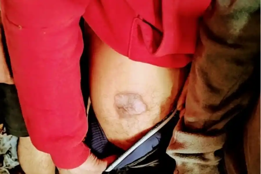 CONSECUENCIAS. Los apresados presentan lesiones en la piel.