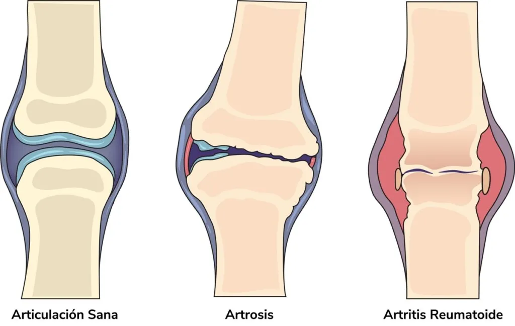 En la artrosis el cartílago que recubre las articulaciones se desgasta.