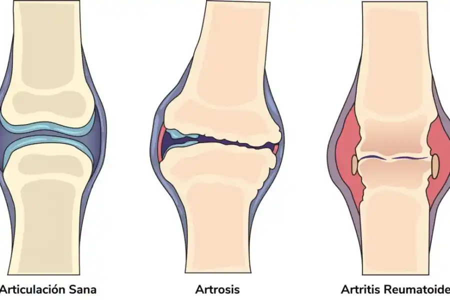 En la artrosis el cartílago que recubre las articulaciones se desgasta.