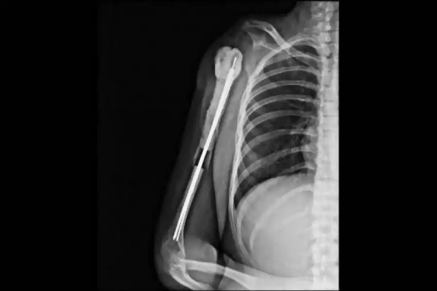 Cirugía inédita: la operaron nueve horas para sacarle un tumor de células gigantes