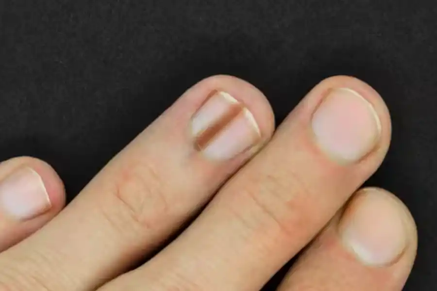 Si aparece esta marca en tus uñas deberías consultar al médico