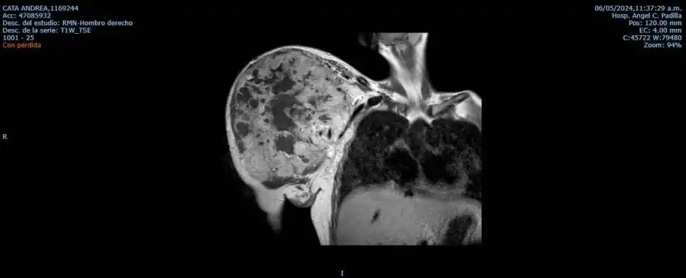 ANTES Y DESPUES. Las radiografías muestran cómo quedó el hombro de Andrea.