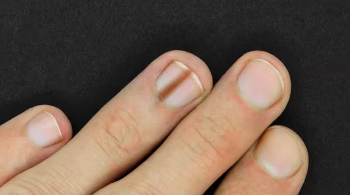 Si aparece esta marca en tus uñas deberías consultar al médico