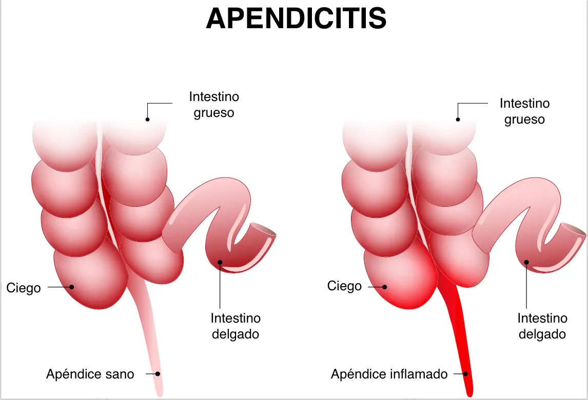 El apéndice está unido a la primera parte del intestino grueso.