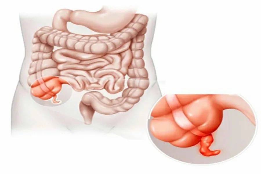 Cuando el apéndice se obstruye se produce la apendicitis.
