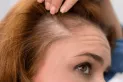 Tratamientos para mujeres para dejar de perder cabello durante la menopausia