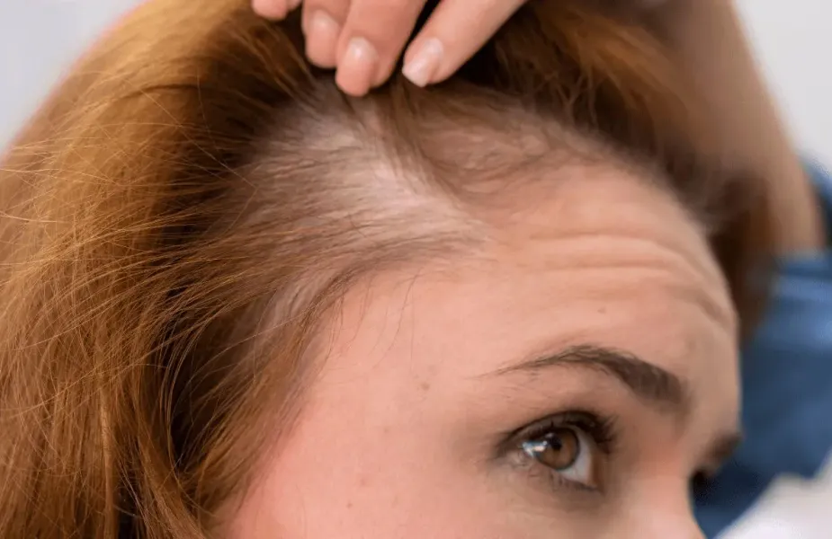 Tratamientos para mujeres para dejar de perder cabello durante la menopausia