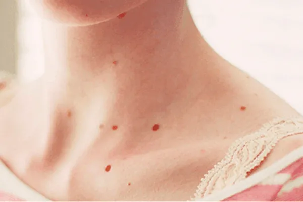 Lunares rojos en la piel: qué son y qué dicen sobre tu salud