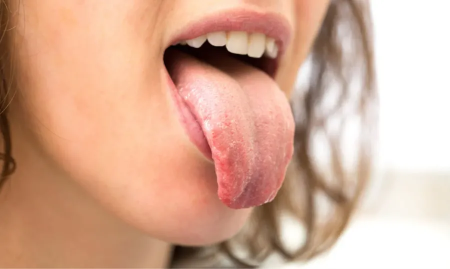 Azúcar alta: un síntoma se manifiesta en la boca