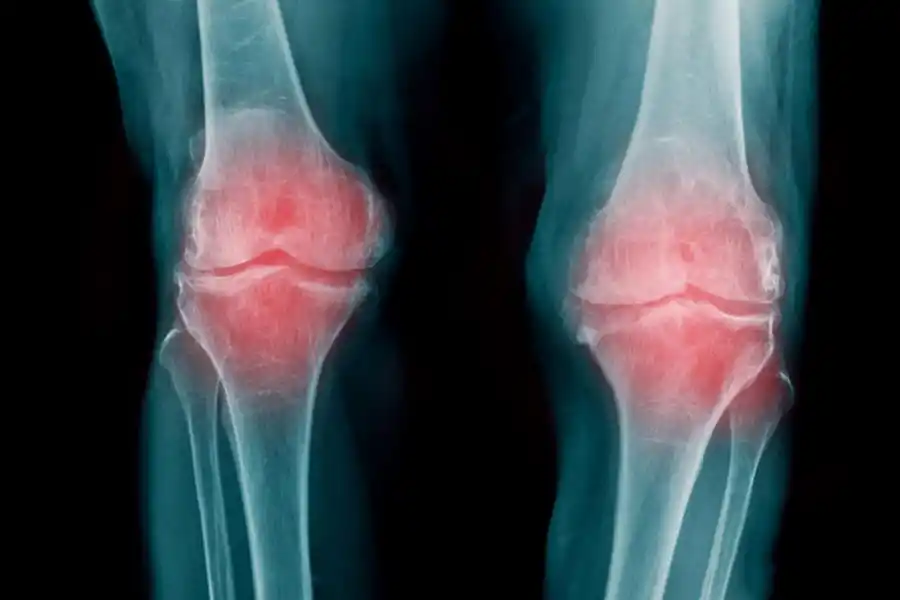 En la artrosis el cartílago que recubre las articulaciones se desgasta.