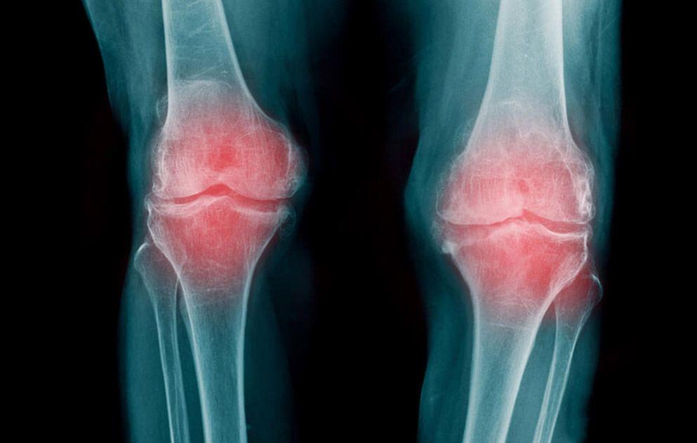 En la artrosis el cartílago que recubre las articulaciones se desgasta.