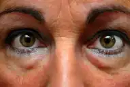 Bolsas debajo de los ojos: cuáles son las causas y qué enfermedades pueden estar relacionadas