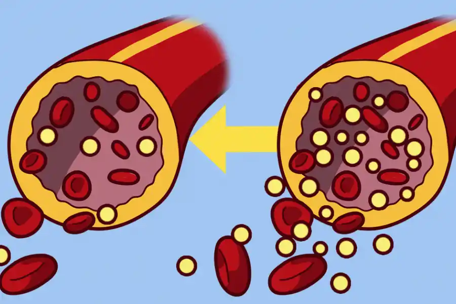 Los altos niveles de azúcar en sangre pueden promover enfermedades como la diabetes.