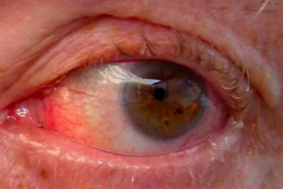 Glaucoma, la enfermedad silenciosa de los ojos provocada por la diabetes que “roba la visión”