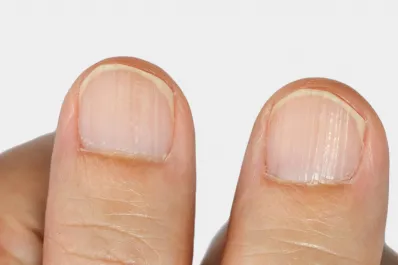 Las rayas en las uñas pueden advertir sobre problemas salud: ¿por qué surgen?