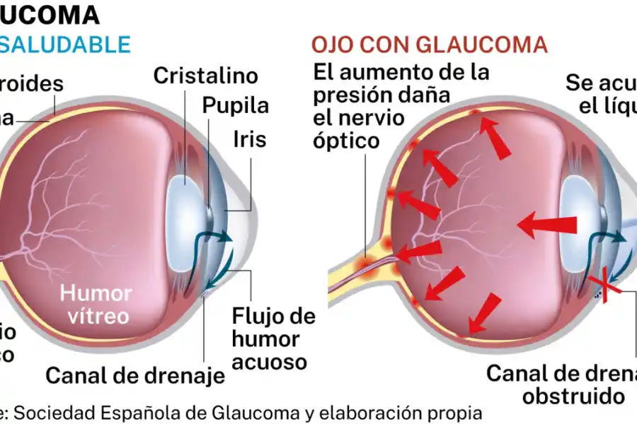 La diabetes produce el daño de los vasos sanguíneos.