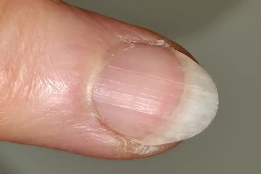 ¿Qué significa tener rayas en las uñas?