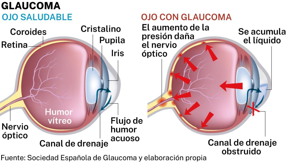 La diabetes produce el daño de los vasos sanguíneos.