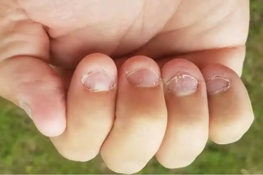 Así lucen nuestras uñas cuando las comemos