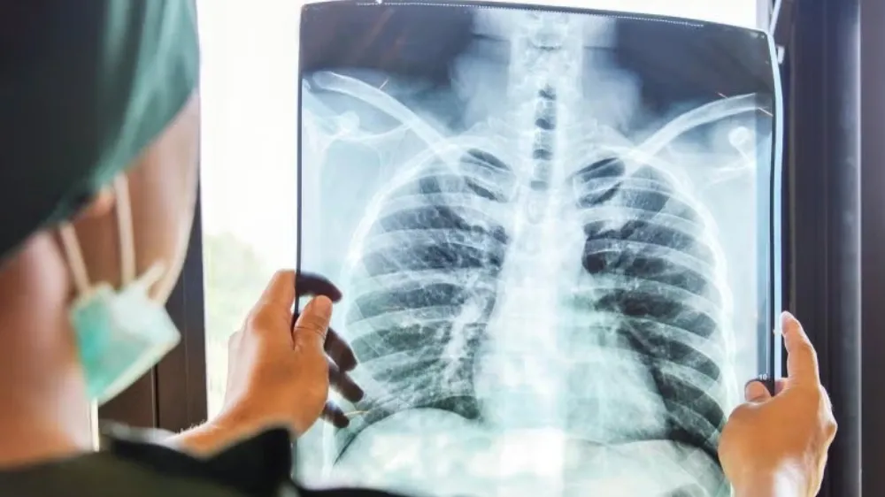 ¿Cómo empieza el cáncer de pulmón?: Una mujer contó cuál fue el primer síntoma que notó