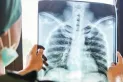¿Cómo empieza el cáncer de pulmón?: Una mujer contó cuál fue el primer síntoma que notó
