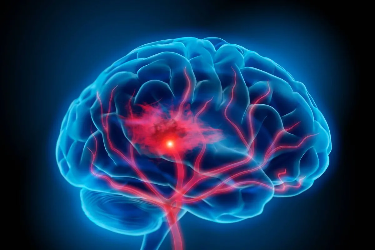 ¿Qué es una embolia cerebral y por qué se produce?