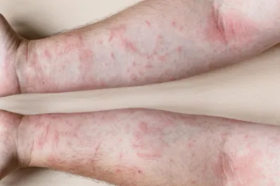 ¿Cómo empieza el lupus?: los primeros síntomas que pueden confundirse con los de otras enfermedades