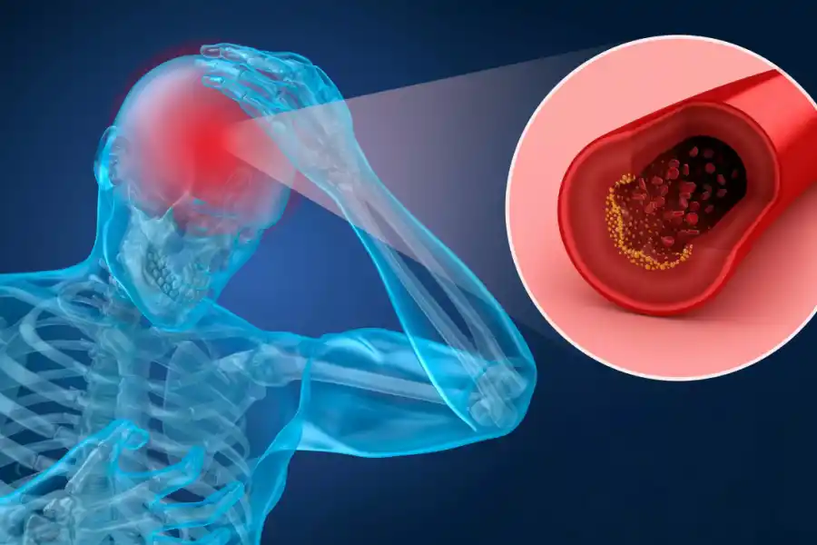 ¿Cómo influye el estrés en la embolia cerebral?