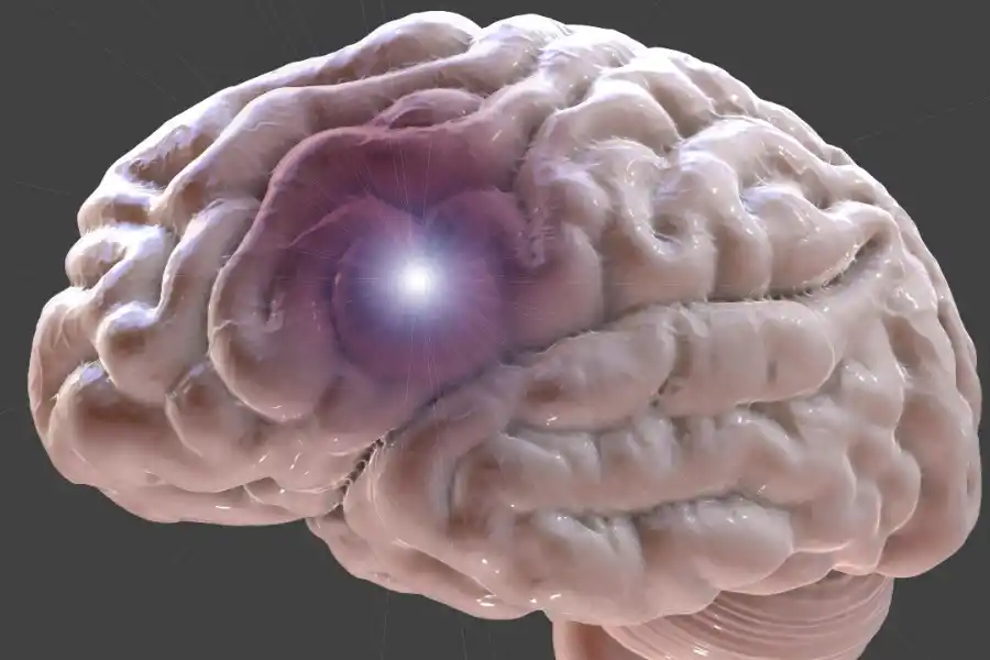 La embolia cerebral se produce por un coágulo que viaja hasta el cerebro.