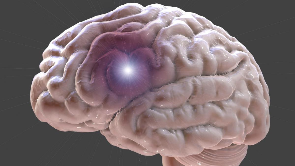 La embolia cerebral se produce por un coágulo que viaja hasta el cerebro.