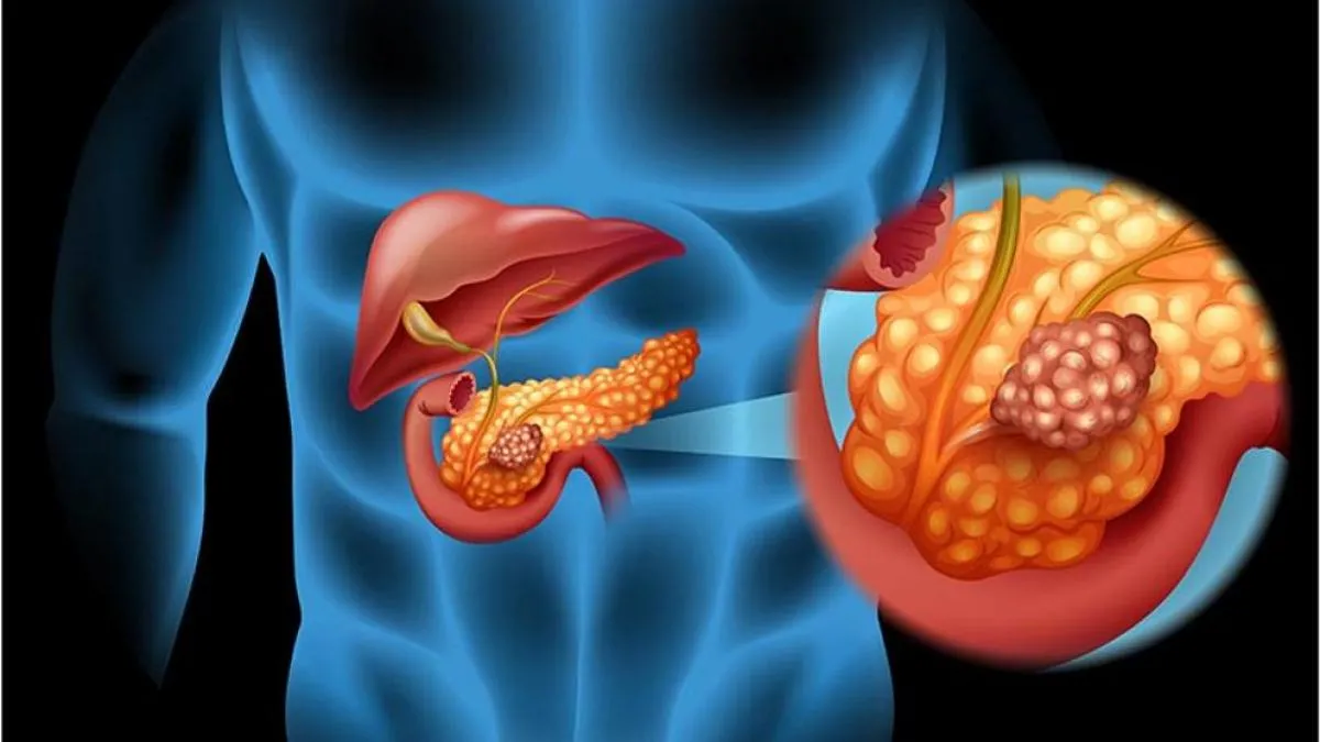 Cuáles son los factores que aumentan el riesgo de desarrollar cáncer de páncreas, según Harvard