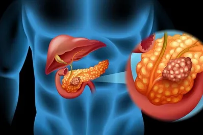 No lo ignores: lo que Harvard descubrió sobre las causas del cáncer de páncreas