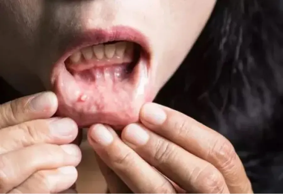 Estas son las prácticas que incrementan el riesgo de tener cáncer de boca