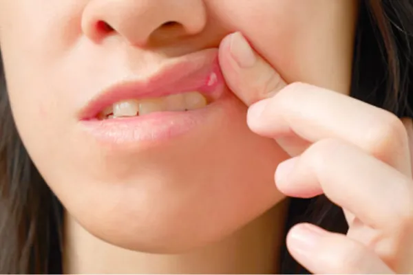 Las seis señales habituales que alertan un posible cáncer de boca