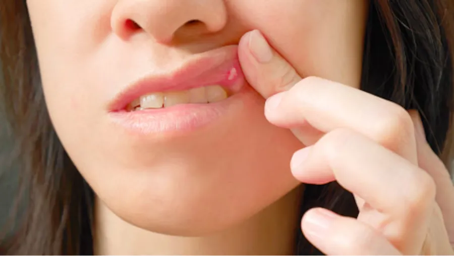 Las seis señales habituales que alertan un posible cáncer de boca