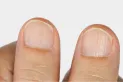 ¿Qué enfermedades pueden significar las uñas rayadas?