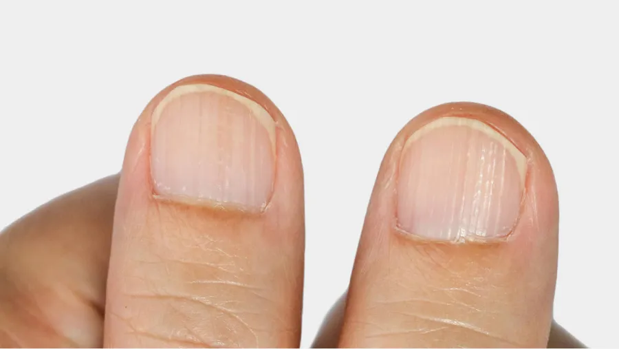 Las líneas en las uñas pueden deberse a deficiencias nutricionales, traumatismos repetitivos o enfermedades 