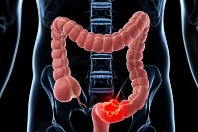 ¿Cómo comienza un cáncer intestinal? El primer síntoma que notó un joven deportista que pudo recuperarse