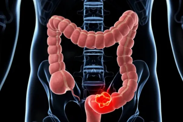 ¿Cómo comienza un cáncer intestinal? El primer síntoma que notó un joven deportista que pudo recuperarse