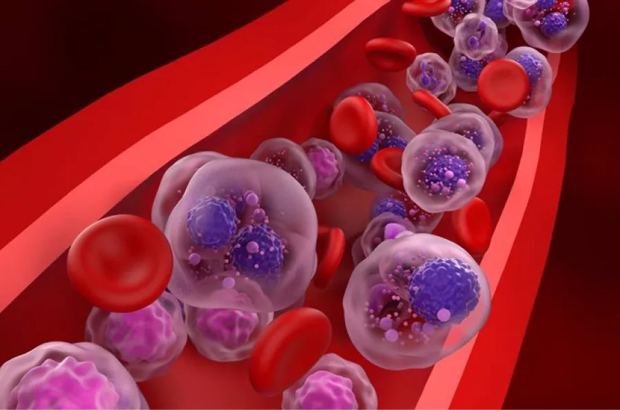 El mieloma múltiple ataca las células plasmáticas, un tipo de glóbulo blanco que tiene la función de producir anticuerpos para combatir infecciones.