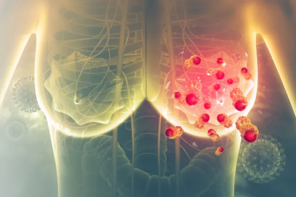 Cáncer de mama: cómo comienza y cuáles son los síntomas iniciales