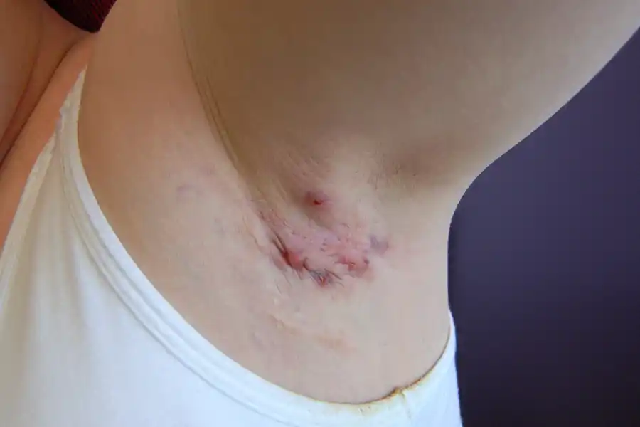 Una de las lesiones de la hidradenitis supurativa se manifiesta en las axilas