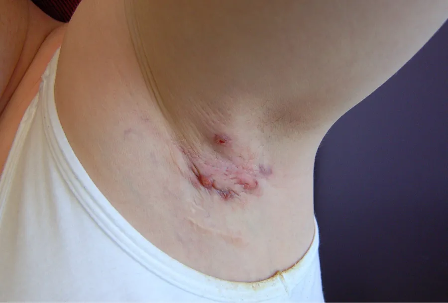 Una de las lesiones de la hidradenitis supurativa se manifiesta en las axilas