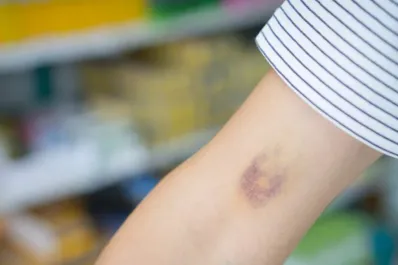 ¿Por qué me salen moretones sin haberme golpeado? La explicación de los especialistas