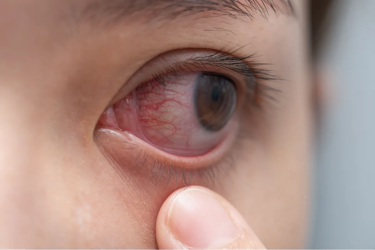 Las consecuencias del lagoftalmos nocturno.