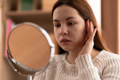 Hígado graso: ¿cuáles son los síntomas que aparecen en la piel y en la cara?