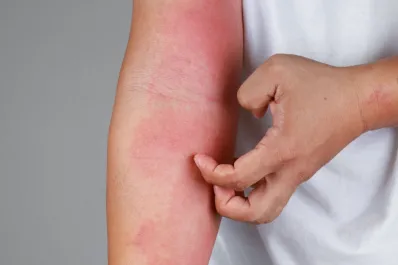 ¿Por qué me pica todo el cuerpo? Estas son las causas más comunes