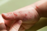 ¿Cómo empieza la viruela del mono y de qué manera se puede evitar el contagio?